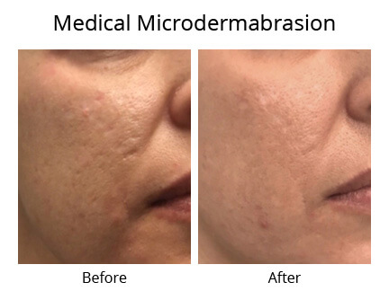 Best Microdermabrasion Treatment in South Delhi