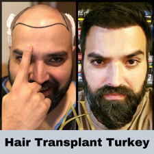 Profile picture of Hair Transplant Turkey
